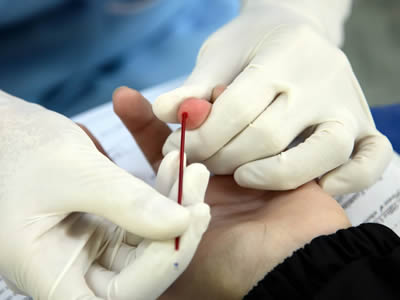 A doctor is taking a precision capillary glass tube to the patient for blood.